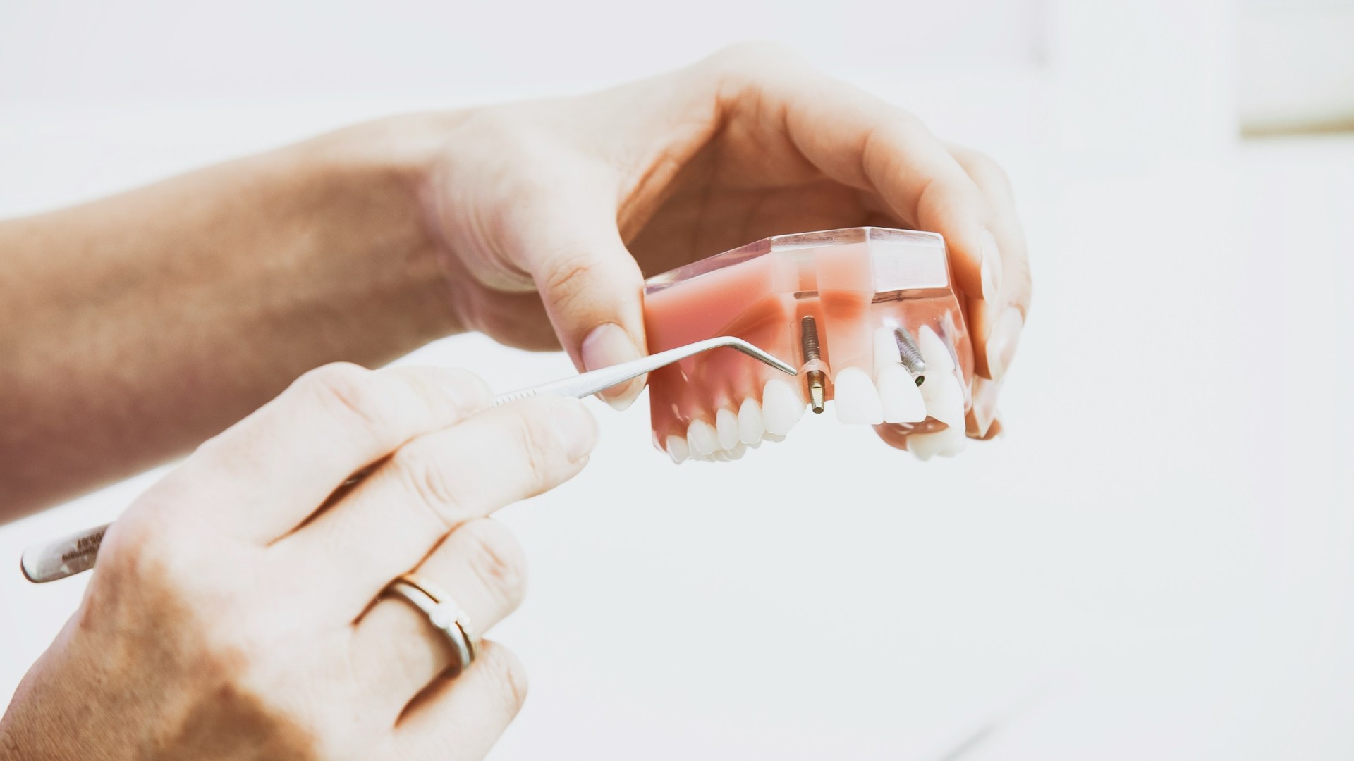 8 мита за зъбните импланти, които трябва да знаете